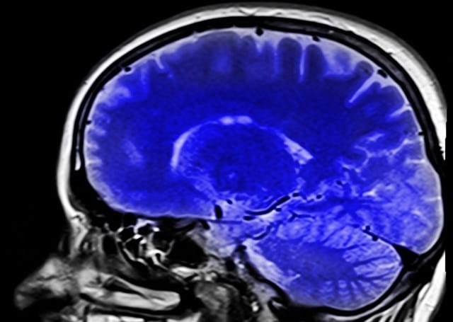 Que signifie rêver de cerveau ?