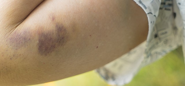 Pourquoi rêver de hématome ?