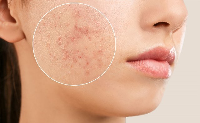 Que signifie un rêve d’acné ?