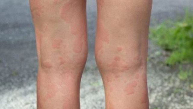 Que signifie rêver de boutons sur les jambes ?