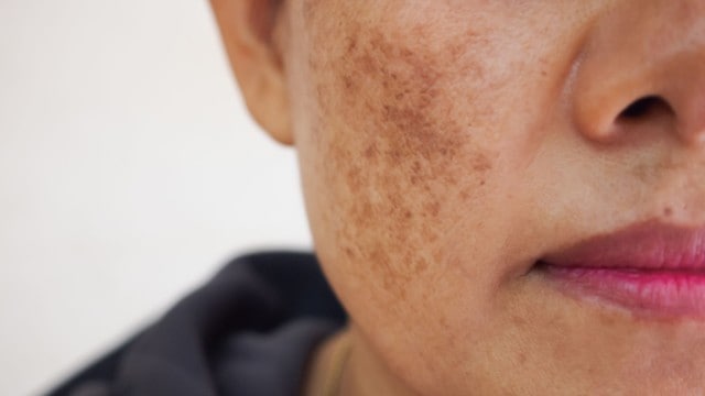 Que signifie rêver de taches sur le visage ?