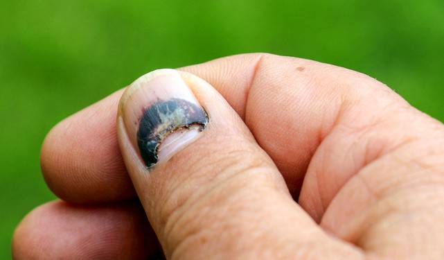 Un rêve de perdre un ongle et sa signification: Pourquoi rêver de perdre un ongle ?